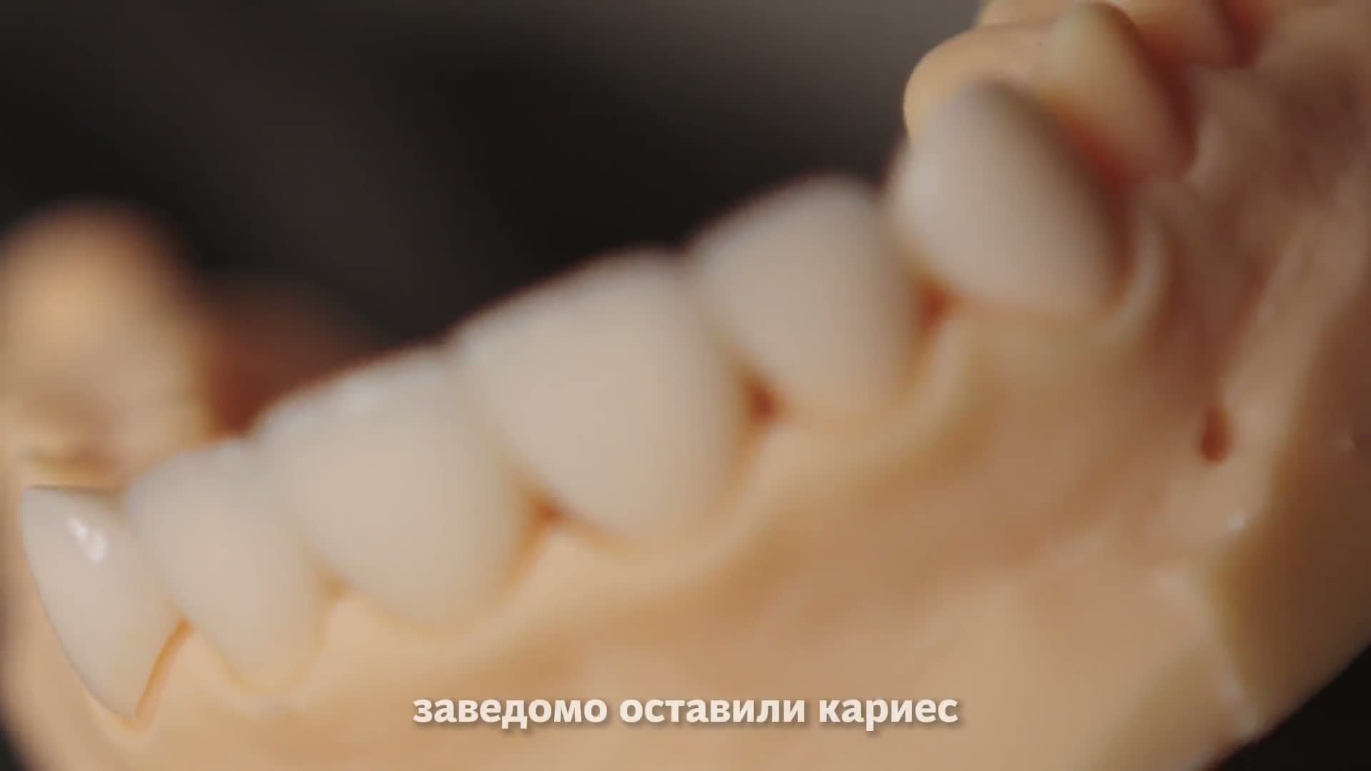 Видео о лечении кариеса